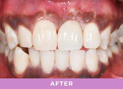 After replacing missing tooth with dental implant